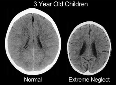Picture of a 3-year-old normal brain, and a brain that shows extreme neglect